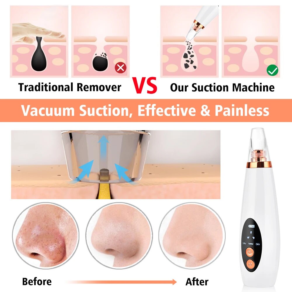 Pore Cleanser, Vacuum Suction, Acne Removal